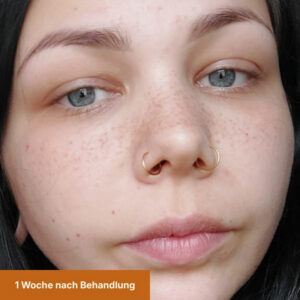 Freckles 1 Woche