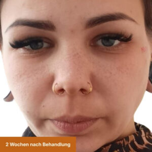 Freckles 2 Wochen Nach Behandlung