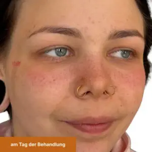 Freckles am Tag der Behandlung