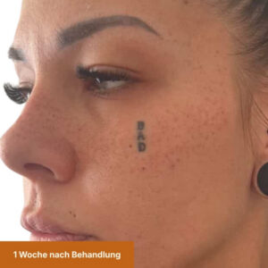 Freckles nach 1 Woche