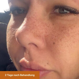 Freckles nach 2 Tagen