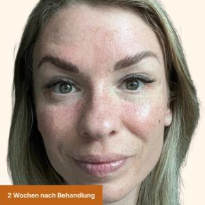 Freckles nach 2 Wochen