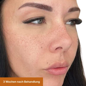 Freckles nach 3 Wochen