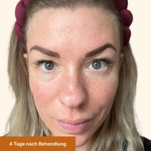 Freckles nach 4 Tagen