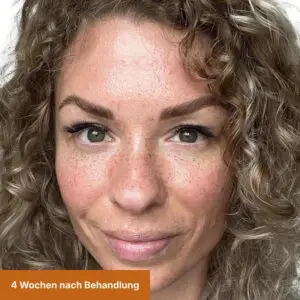 Freckles nach 4 Wochen